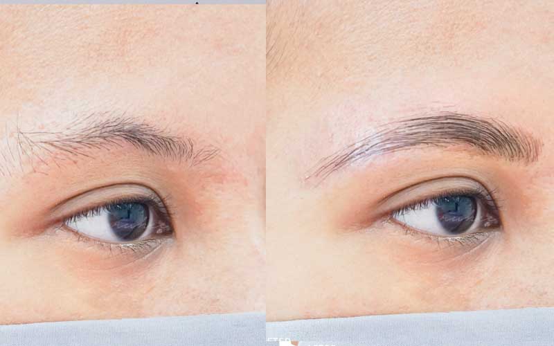 Brow Lift dari Ruhee