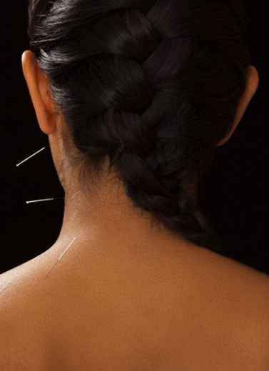 Akupunktur Atas Kerontokan Rambut