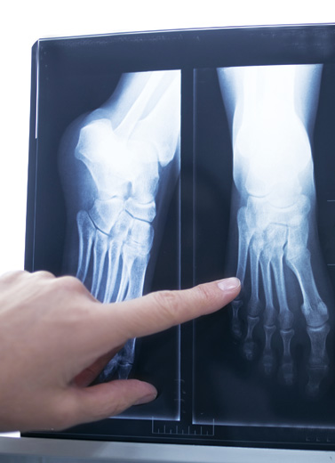 Osteopenia atau Osteoporosis?